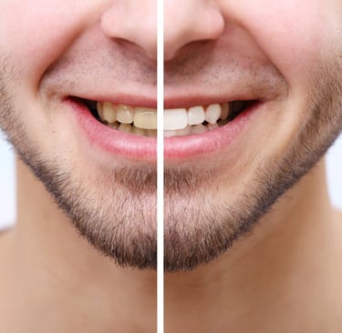 A smiling man with a before and after teeth whitening split image.