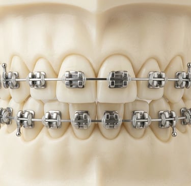 Modelo odontológico de arcada dentária com aparelho ortodôntico fixo metálico tradicional.