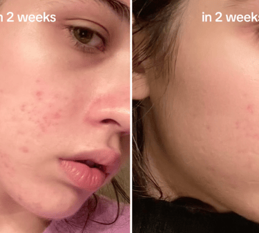 Before and after skin transformation showing reduction in facial acne and redness over two weeks.