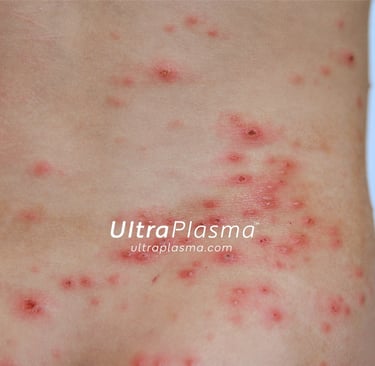 ultraplasma.com_chicken-pox-rash_treatment_su_cicegi_tedavi_ultra_plasma_ultra_plazma