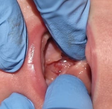 baby with tongue-tie division