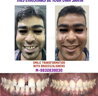 Before and after smile transformation results using orthodontic braces and clear aligners.