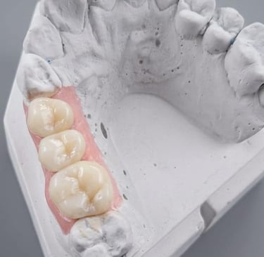 coronas posteriores de zirconia porcelana