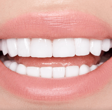 Veneers in Naples FL – Answers to Top Patient Questions by Dr. Kristina Taranov DDS