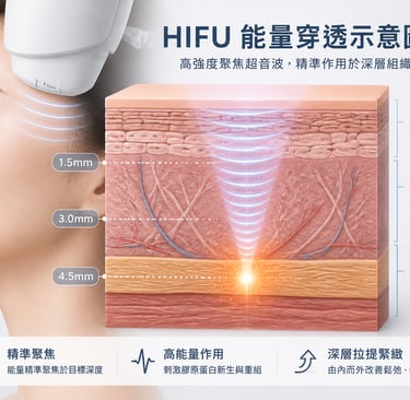 HIFU能量穿透示意圖