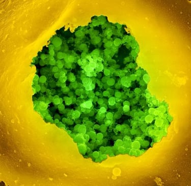 Chlamydia Pneumoniae infecting a human cells and damaging mitochondrial activity.