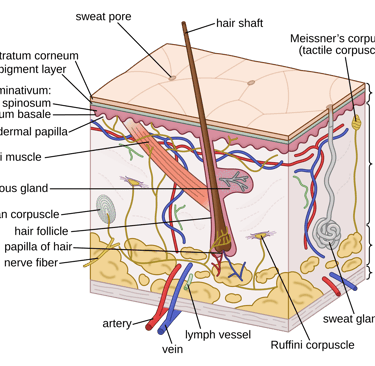 Diagram showing sweat gland duct blocked by dead cells and bacteria, causing trapped sweat and infla