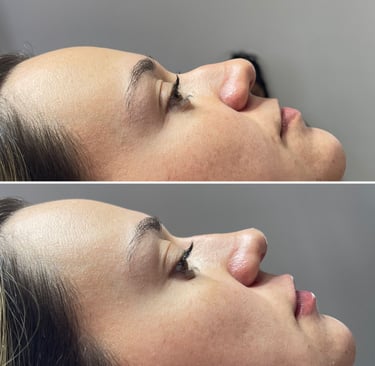 a woman with a nose job on her nose and nose