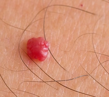 LASER treatment of cherry angiomas in Gateshead