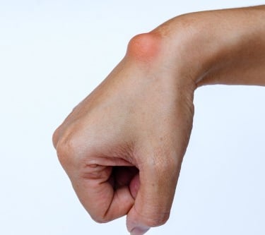 Wrist ganglion and digital mucous cyst treatments.