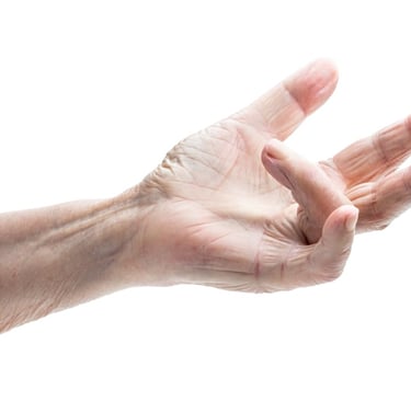Dupuytrens contracture of the hand and finger