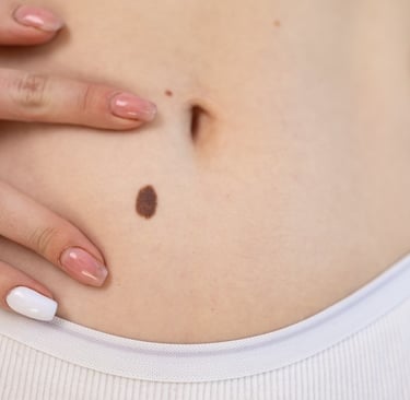 Worried about a mole or mark on the skin?