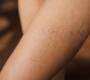 Spider veins on the skin treated with LASER in Gateshead. 
