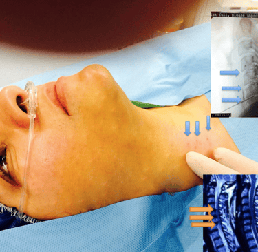 Multileve Cervical Disc Herniation treated by Discogel injection