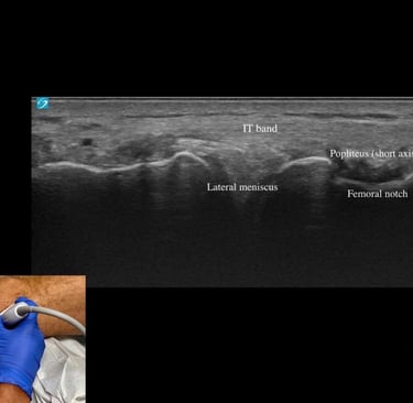 echographie genou diagnostic gonflement genou