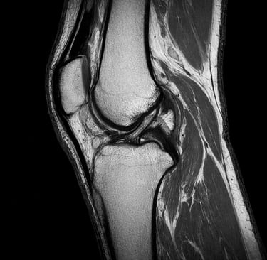 IRM genou diagnostic douleur genou