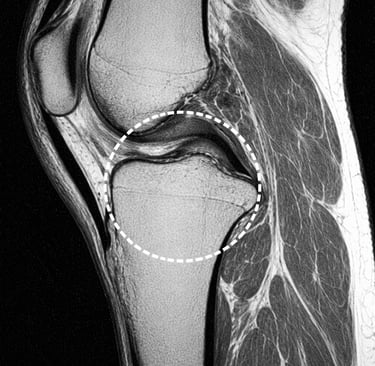 IRM genou menisque lesion