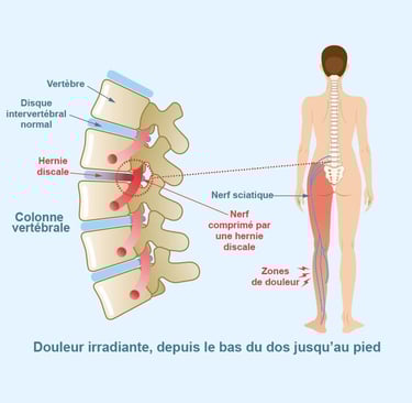 Trajet du nerf sciatique et douleur causée par une hernie discale lombaire