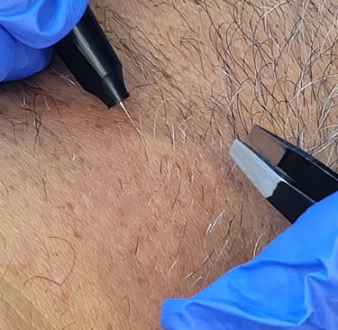 Hair removal electrolysis Edmonton at Ariana esthetic clinic 