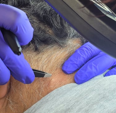 Permanent hair removal Electrolysis Edmonton