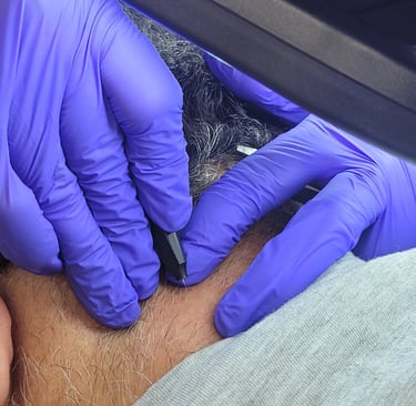 Hair removal Electrolysis Edmonton