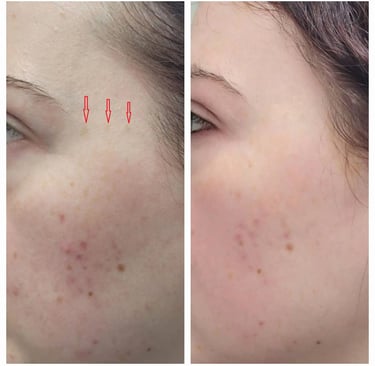 Age spot treatment in a woman at Ariana Esthetic Edmonton