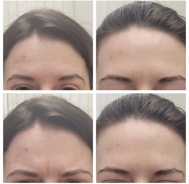 Dysport injection at Ariana Esthetic in Edmonton