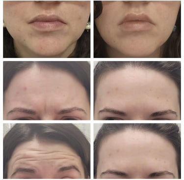Dysport injection at Ariana Esthetic in Edmonton