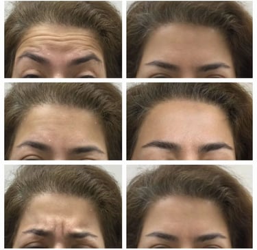 Dysport injection at Ariana Esthetic in Edmonton