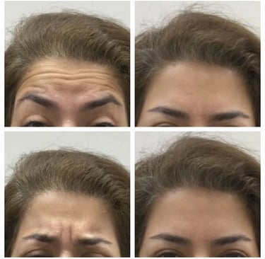 Dysport injection at Ariana Esthetic in Edmonton