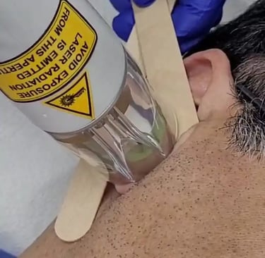 Ear hair removal laser at Ariana Esthetic Edmonton