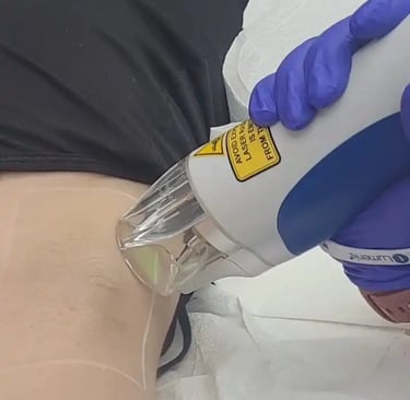 Underarms hair removal laser at Ariana Esthetic Edmonton