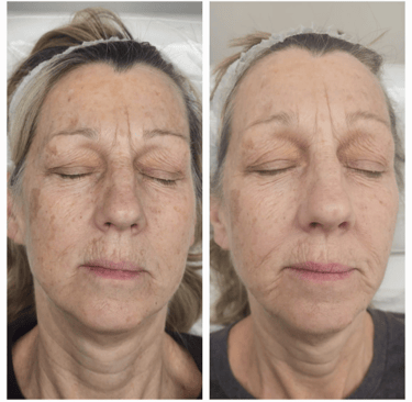 Before and after just 2 session of treatment at Ariana Esthetic Edmonton