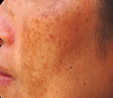 Melasma treatment at Ariana Esthetic Edmonton