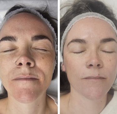 Before and after peeling at Ariana Esthetic Edmonton