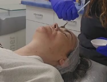 Peeling at Ariana Esthetic Edmonton