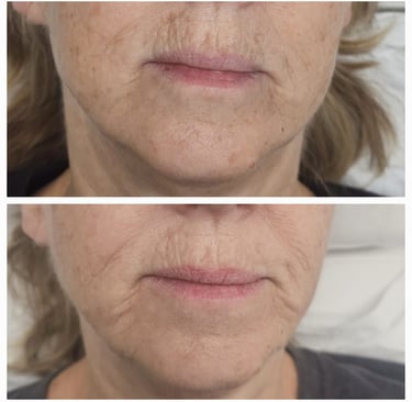 Before and after ResurFX treatment at Ariana Esthetic Edmonton