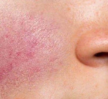 Rosacea in a young girl