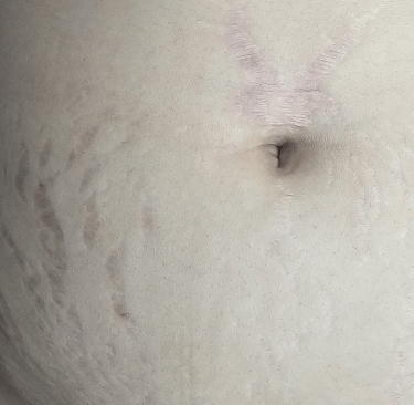 Stretch marks before treatment in a young woman following pregnancy