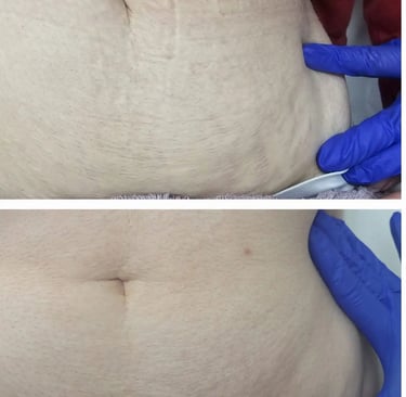 Significant improvement results in abdominal stretch mark treatments at Ariana Esthetic Edmonton.