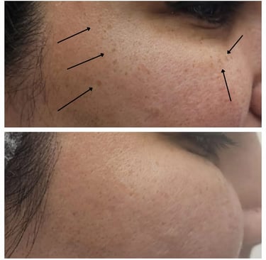 Freckle treatment at Ariana Esthetic Clinic Edmonton, using advanced technology.
