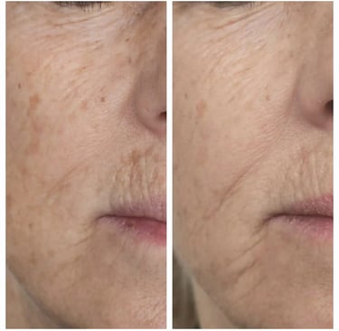 Before and after of treatment at Ariana Esthetic Edmonton