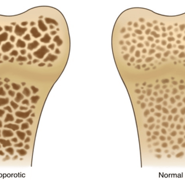 a comparison of a bone bone bone bone bone bone bone bone bone bone bone bone