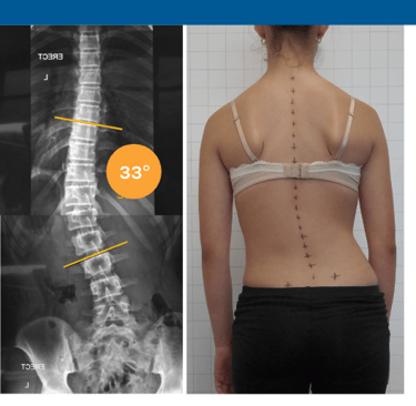 Scoliosis management, Precision center in Muscat