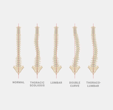 Scoliosis treatment in precision center in Muscat.