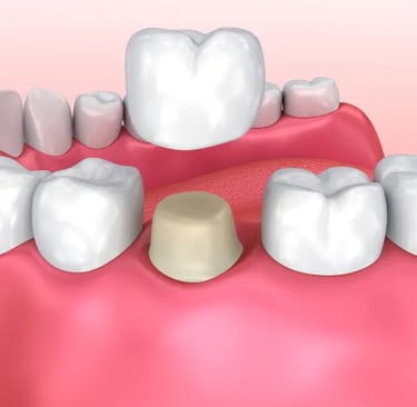 Diagram showing a ceramic dental crown being placed over a prepared tooth on the lower jaw.