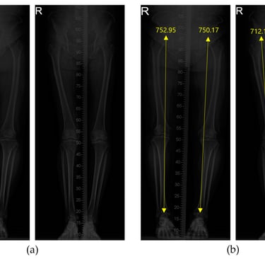 Visual representation of leg length analysis