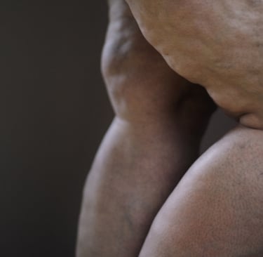 Perna com lipedema