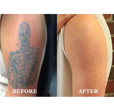 Tattoo Removal - Tattoo Baba - Best Tattoo Studio In Jaipur