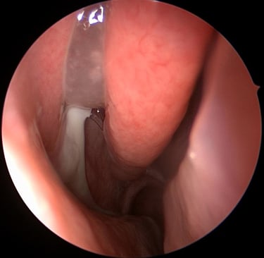 cirurgia endoscópica sinusite